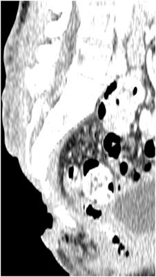 3D Volumetric Modeling and Microvascular Reconstruction of Irradiated Lumbosacral Defects after Oncologic Resection